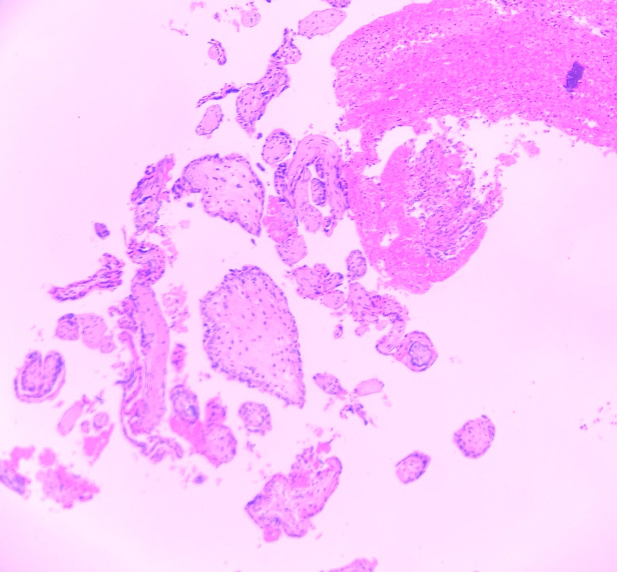 Praachy27's tweet photo. POC with evident foetal parts. #APCON2022 #APCON2022PathTwitter #crittersontwitters @smlungpathguy @Swathiprabhu5 @VijayPatho @archibhat3 @DrGeeONE #gynaecpath @Pathologists @ThePathologist2 @PathTweetAward https://t.co/kmQ8ufAYGw