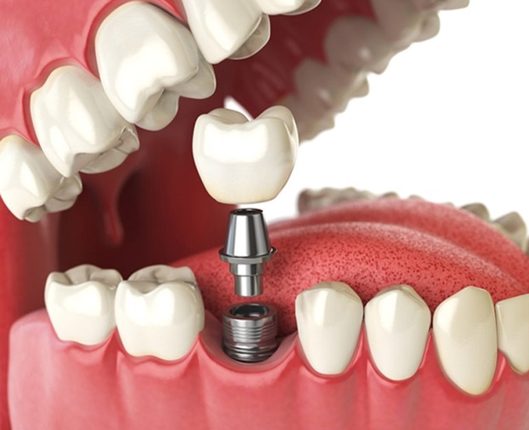 Tek Diş İmplant
Tek diş implant tedavisinde kullanılan implantlar, yapay dişinize bir yapı ve temel sağlarlar. 
#implant #tekdişimplant #implantdiş #implantdiştedavisi #birgündeimplant #implantdişhekimi #ömerkutay
omerkutay.com/tek-dis-implant