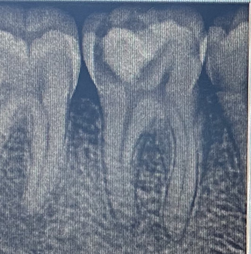 Rct for #46
Dx. SIP with SAP
Mesial canals 2-1