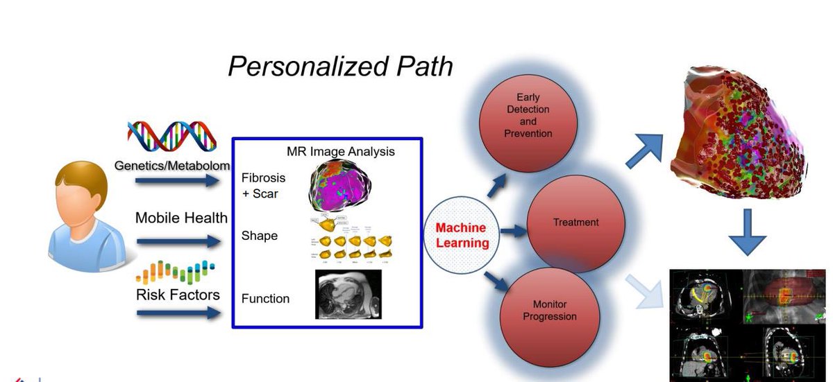 Christian Sohns (@chris_sohns) on Twitter photo Personalized paths for VT ablation using ⚡️💥radiosurgery. Thank you <a href="/RolandTilz/">Roland Tilz</a> for inviting us to the 3. German Radiosurgery Workshop <a href="/Phiso_de/">Philipp Sommer</a> <a href="/DoctorPhillEP/">Phillip Cuculich, MD</a> <a href="/nmarrouche/">Nassir Marrouche</a> <a href="/SamuelSossalla/">Samuel Sossalla</a> <a href="/AGEP_DGK/">AGEP</a> <a href="/AG21_DGK/">AG 21 - Kardiale Magnetresonanztomographie</a> Personalized paths for VT ablation using ⚡️💥radiosurgery. Thank you <a href="/RolandTilz/">Roland Tilz</a> for inviting us to the 3. German Radiosurgery Workshop <a href="/Phiso_de/">Philipp Sommer</a> <a href="/DoctorPhillEP/">Phillip Cuculich, MD</a> <a href="/nmarrouche/">Nassir Marrouche</a> <a href="/SamuelSossalla/">Samuel Sossalla</a> <a href="/AGEP_DGK/">AGEP</a> <a href="/AG21_DGK/">AG 21 - Kardiale Magnetresonanztomographie</a> 