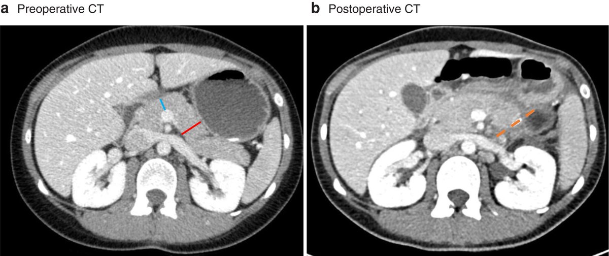BJS (@bjsurgery) on Twitter photo OA in Nov's BJS: Development&external validation of DISPAIR fistula risk score for postoperative pancreatic fistula risk after distal pancreatectomy academic.oup.com/bjs/article/10… <a href="/bplwijn/">Bas Wijnhoven</a> <a href="/des_winter/">Des Winter</a> <a href="/ksoreide/">Kjetil Søreide</a> <a href="/MalinASund/">Malin Sund</a> <a href="/evanscolorectal/">Martyn Evans</a> <a href="/nfmkok/">Niels Kok</a> <a href="/paulo_sutt/">Paul Sutton</a> <a href="/robhinchliffe1/">Robert Hinchliffe</a> <a href="/young_bjs/">Young BJS</a> OA in Nov's BJS: Development&external validation of DISPAIR fistula risk score for postoperative pancreatic fistula risk after distal pancreatectomy academic.oup.com/bjs/article/10… <a href="/bplwijn/">Bas Wijnhoven</a> <a href="/des_winter/">Des Winter</a> <a href="/ksoreide/">Kjetil Søreide</a> <a href="/MalinASund/">Malin Sund</a> <a href="/evanscolorectal/">Martyn Evans</a> <a href="/nfmkok/">Niels Kok</a> <a href="/paulo_sutt/">Paul Sutton</a> <a href="/robhinchliffe1/">Robert Hinchliffe</a> <a href="/young_bjs/">Young BJS</a>