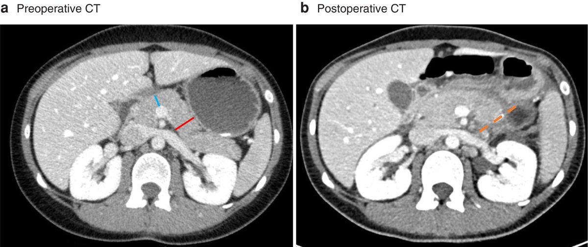 OA in Nov's BJS: Development&external validation of DISPAIR fistula risk score for postoperative pancreatic fistula risk after distal pancreatectomy academic.oup.com/bjs/article/10… @bplwijn @des_winter @ksoreide @MalinASund @evanscolorectal @nfmkok @paulo_sutt @robhinchliffe1 @young_bjs