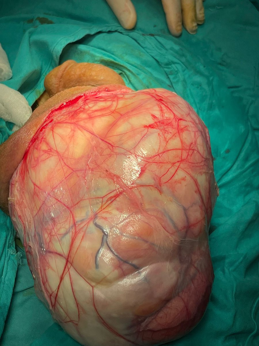 I thought I’d seen everything. But that is not true. 61 yo patient with a huge testicular mass. Even he was using his wife’s scarf to carry. 🤔Inguinal excision was not possible and the pathology is liposarcoma. <a href="/itfuroloncology/">İTF Üroloji A.D. Ürolojik Onkoloji Bilim Dalı</a> <a href="/Selcuk__Erdem/">Selcuk Erdem</a> <a href="/itfuroloji/">İ.Ü. İ.T.F. Üroloji</a>