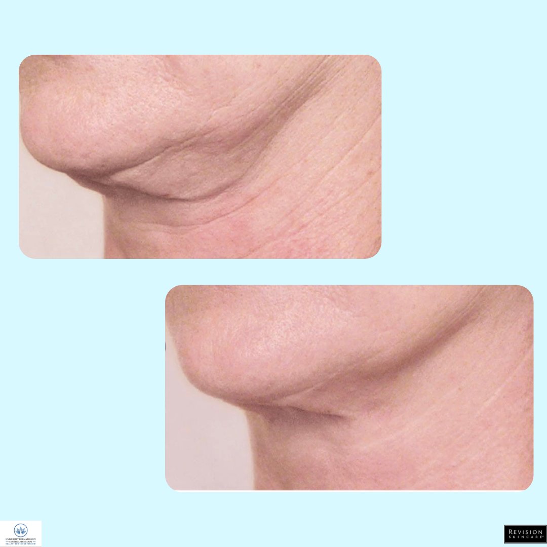 UDCDerm2017's tweet photo. An amazing before and after of a 6 week study with our product of the month, Nectifirm!! Nectifirm is 20% off this month only, or receive a free Nectifirm with the $1,000 purchase of a Laser Genesis package!!
#ProductOfTheMonth #RevisionSkincare #Nectifirm #UDCMedSpa #IN https://t.co/Y1dxZBogVF