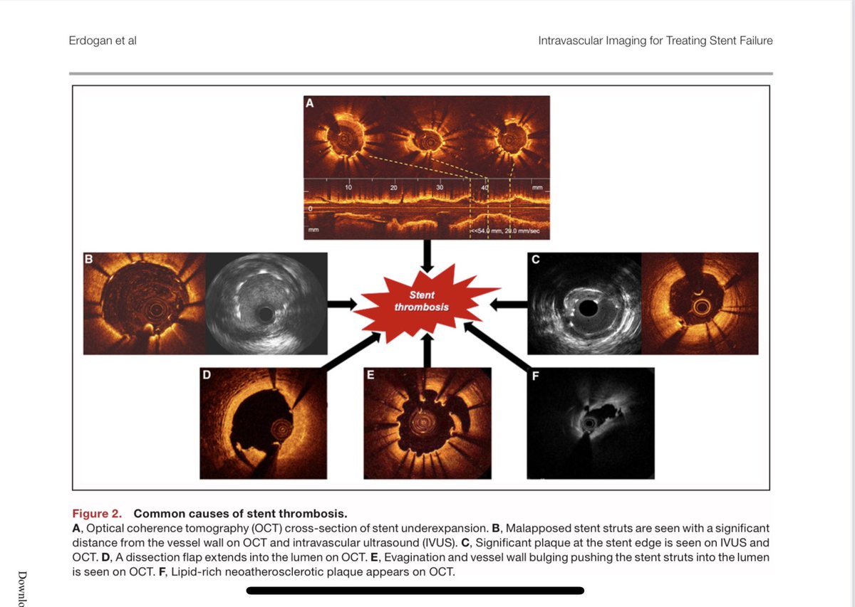 emraherdoganmd's tweet photo. 🔥 Check out our new paper, just publish @JAHA_AHA   @baumbach_a @mmamas1973 @mirvatalasnag @TKDsosyal @hect2701 @AlexandraLansky  @EAPCIPresident @MilasinD18  @medicineinasuit @AnthonyMathur  @Steph_Achenbach @aayshacader @BartsIntervGrp @m_degertekin https://t.co/fmkc3bm99E https://t.co/0B5hUsnc7Q