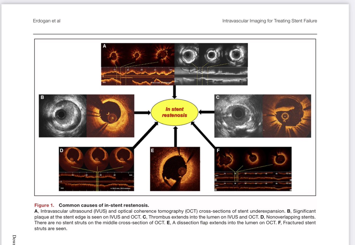 emraherdoganmd's tweet photo. 🔥 Check out our new paper, just publish @JAHA_AHA   @baumbach_a @mmamas1973 @mirvatalasnag @TKDsosyal @hect2701 @AlexandraLansky  @EAPCIPresident @MilasinD18  @medicineinasuit @AnthonyMathur  @Steph_Achenbach @aayshacader @BartsIntervGrp @m_degertekin https://t.co/fmkc3bm99E https://t.co/0B5hUsnc7Q