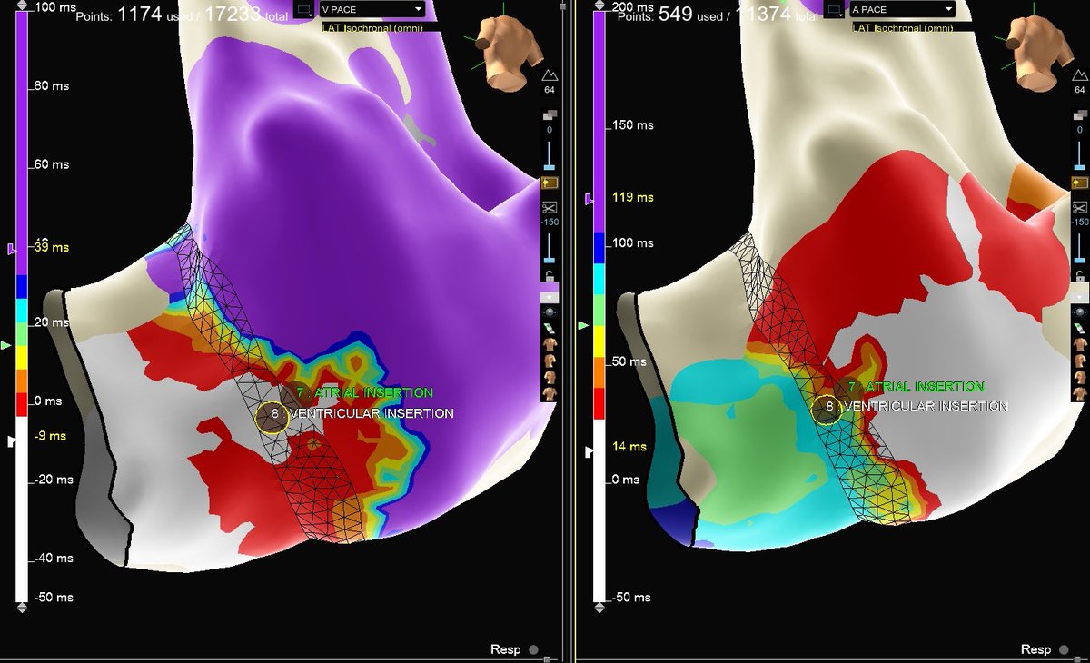 Omnipolar map with HD GRID. Activation arrows highlight precise slant of accessory pathway, one burn term. #EPeeps #HDGrid #Omnipolar #EPHeart <a href="/memorialhermann/">Memorial Hermann</a> <a href="/UTHealthHouston/">UTHealth Houston</a> #cardiotwitter #medtwitter