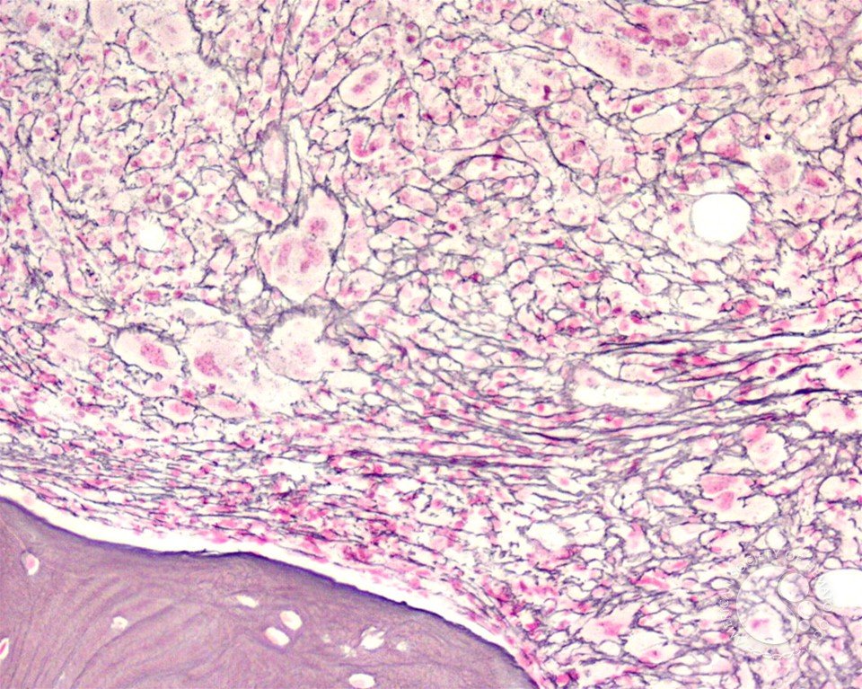 Let's talk about bone marrow fibrosis in myelofibrosis. When we hear fibrosis, we think lung (IPF) or liver (cirrhosis), devastating conditions. The beauty about marrow fibrosis: it's reversible with allogeneic BMT. Let's start🧵with new #ASH22 abstracts #mpnsm #MedTwitter /19