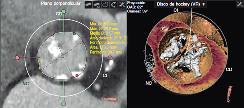👤 Caso clínico: Papel del acceso transeptal en TAVI en un paciente con estenosis aórtica sobre válvula bicúspide incruzable. <a href="/juliamsole/">Julia Martínez Solé</a> <a href="/LozanoEdo/">Silvia Lozano Edo</a> <a href="/francisco_morro/">Francisco Ten Morro</a> <a href="/LalagunaLuis/">Luis María Andrés Lalaguna</a> <a href="/sjorge4/">Jorge Sanz Sánchez</a> <a href="/JL_10_HILL/">Jose Luis Díez Gil</a> recintervcardiol.org/es/caso-clinic…