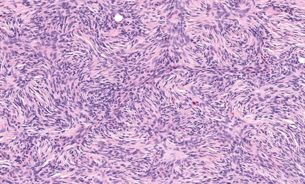 JMGardnerMD's tweet photo. What is the name for this spindle cell pattern? What tumor is it classically seen in?
Answers: https://t.co/vcJU4CaWfh
WSI digital slides: https://t.co/fw8d6qwuGQ
Video: https://t.co/ggziVz67Js 
#pathology #pathologists #pathTwitter #dermpath #dermatology #dermtwitter #BSTpath https://t.co/VazXVFgiLr