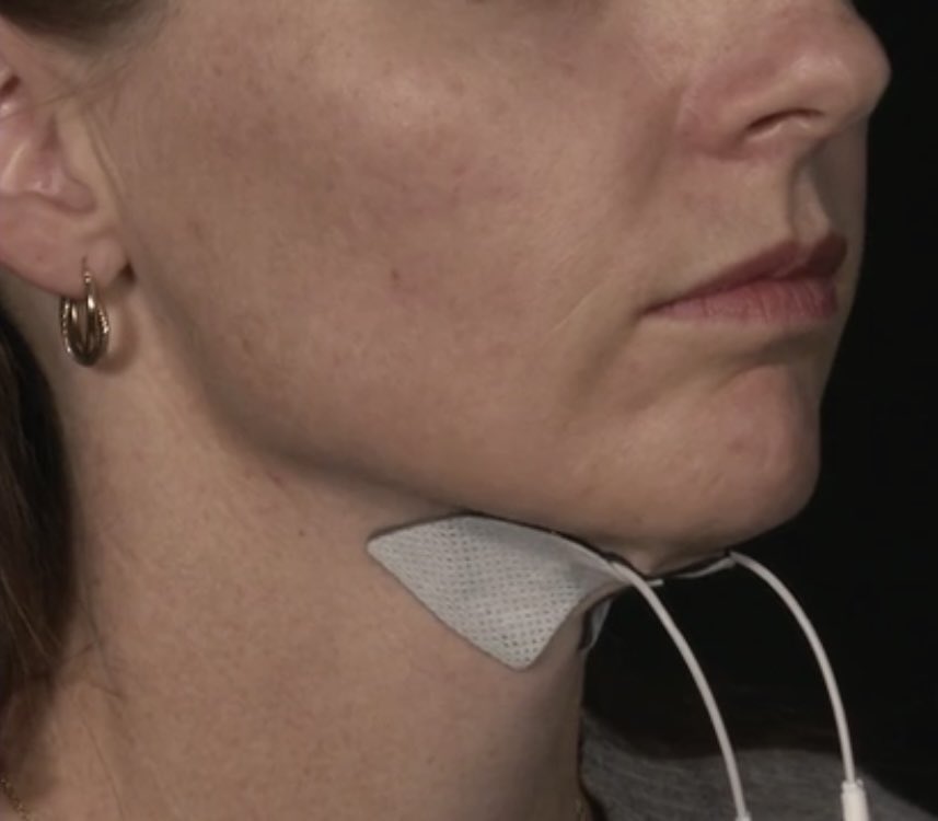 CDDFTSpeechDept's tweet image. Happy tears from the SLT team in videofluoroscopy clinic following intensive @Ampcare for a brain stem stroke patient moving from nil by mouth to normal fluids and level 6 diet in 6 weeks. Top job and great teamwork! #TeamCDDFTSLT #makingadifferenceeveryday @CDDFTSpeechDept