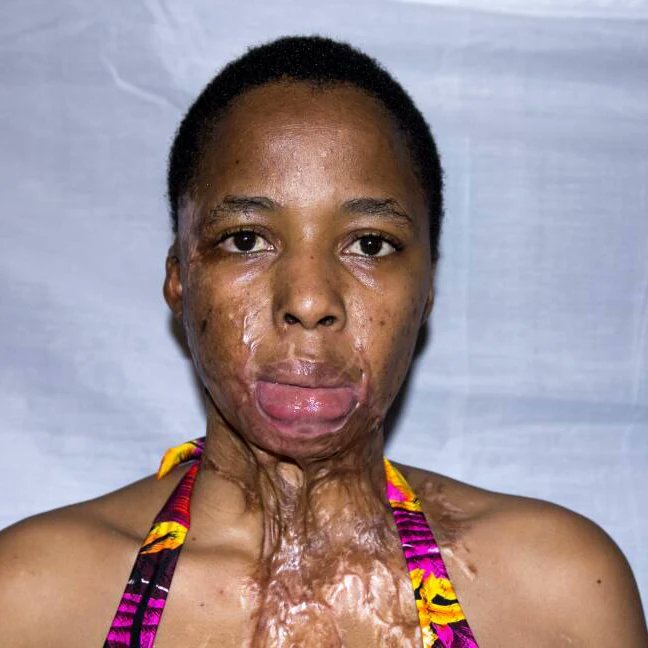 eva_rakitla's tweet photo. How it started after the accident. Modelling has always been my passion not giving up just yet
Modelling with a mission.Advocating for body positivity and exclusion of people with scars in the modelling, fashion and beauty industry.

📸 Kflow Moji Visuals 

#modelingafteraccident https://t.co/ZZVleKuTIF