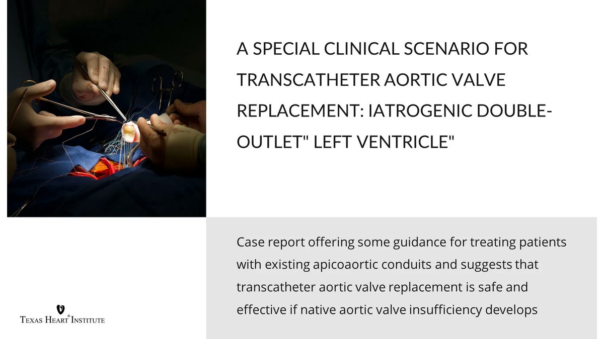 The Texas Heart Institute (@texas_heart) on Twitter photo A special clinical scenario for transcatheter aortic valve replacement: iatrogenic double-outlet" left ventricle" | #THIPubs <a href="/APostalian/">Alexander Postalian, MD</a> <a href="/DeepK352/">Sudeep Kuchibhotla</a> <a href="/koneru_s/">Srikanth Koneru</a> <a href="/nedepper/">Neil E. Strickman MD</a> | <a href="/Texas_Heart/">The Texas Heart Institute</a> #THIJournal buff.ly/3fsGbCj A special clinical scenario for transcatheter aortic valve replacement: iatrogenic double-outlet" left ventricle" | #THIPubs <a href="/APostalian/">Alexander Postalian, MD</a> <a href="/DeepK352/">Sudeep Kuchibhotla</a> <a href="/koneru_s/">Srikanth Koneru</a> <a href="/nedepper/">Neil E. Strickman MD</a> | <a href="/Texas_Heart/">The Texas Heart Institute</a> #THIJournal buff.ly/3fsGbCj