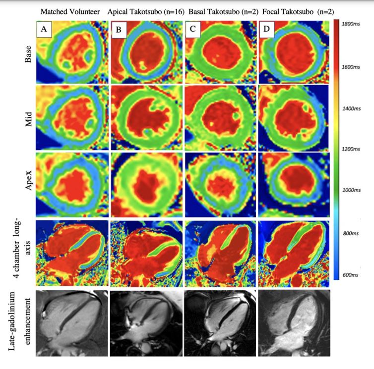 Circulation (@circaha) on Twitter photo #OriginalResearch: Manganese-Enhanced #CMR in Takotsubo syndrome demonstrates acute perturbation in myocardial calcium handling that persists even after recovery of LV systolic function <a href="/dana_dawson16/">Dana Dawson</a> @marcdweck #AHAJournals ahajrnls.org/3t0svBy #OriginalResearch: Manganese-Enhanced #CMR in Takotsubo syndrome demonstrates acute perturbation in myocardial calcium handling that persists even after recovery of LV systolic function <a href="/dana_dawson16/">Dana Dawson</a> @marcdweck #AHAJournals ahajrnls.org/3t0svBy