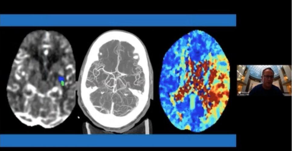 medalityhq's tweet photo. The replay of @JeremyHeitMDPHD's acute ischemic #strokeimaging & #thrombectomy talk is now available!
https://t.co/ViuhP0eyJ2 https://t.co/E9X0WMZp6a