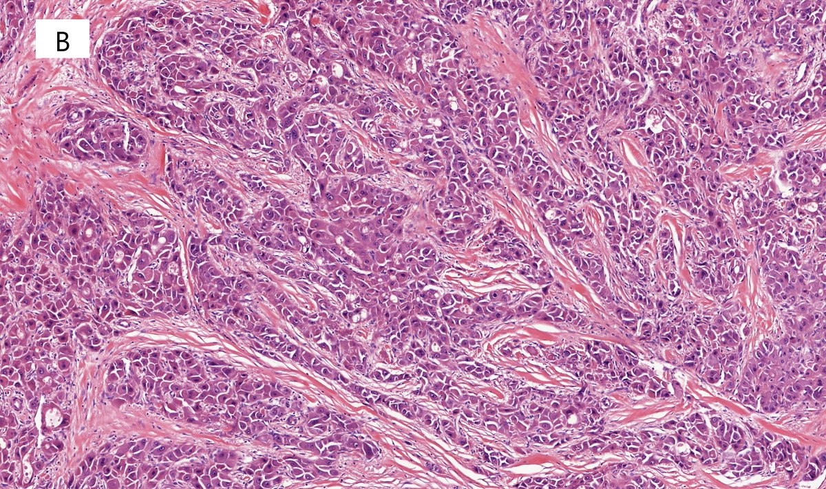 TristanRutland7's tweet photo. 💬Current thoughts:

➡️#Pathtwitter really isn't twitter. Its a collection of wonderful people learning off each other to make the world a better place.

➡️Ill stay in Pathtwitter as long as there are people to teach &amp; learn from.

Anyway question time

❓Name the below tumours❓ https://t.co/nsjvosjq78