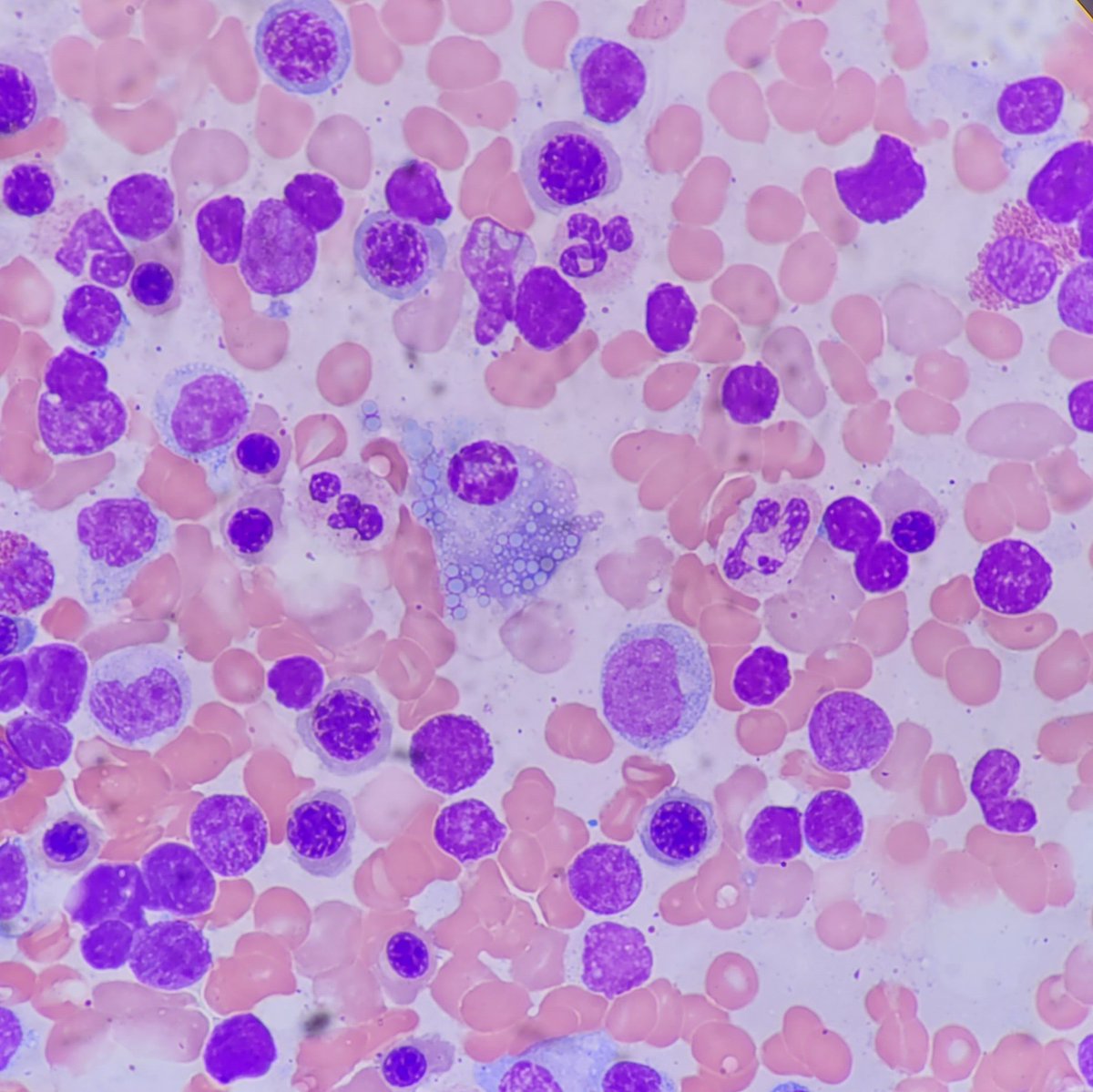 Bubble bubble toil and trouble 😈

#PathTwitter #hemepath #kupath #kumcpathology