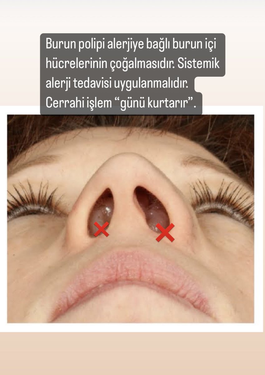 ProfSFindik's tweet photo. #alerji #polip #burun #nazalpolip #alerjikrinit #rinit #alerjikastım #astım #teşhis #tedavi # https://t.co/7S2bGyXaMI