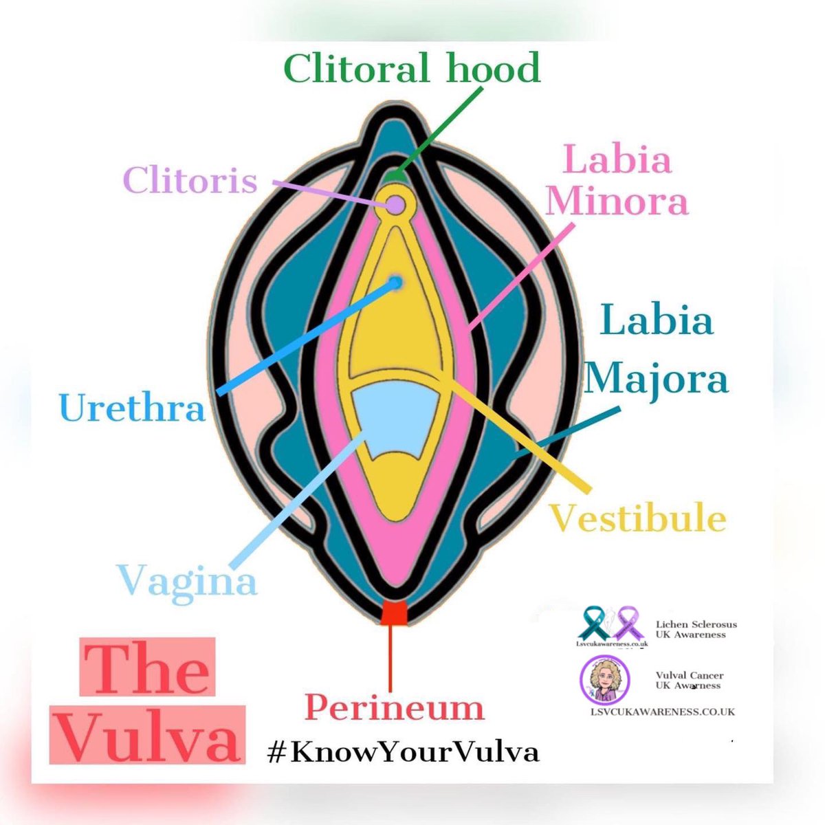 Vulval Cancer UK Awareness (@vulvalcanceruk) on Twitter photo Vulval cancer affects the external part of the female genitalia including the clitoris, labia minora, labia majora, vestibule, perineum and the bartholins glands.
#KnowYourVulva #VulvalCancer
<a href="/LSclerosus/">Lichen Sclerosus UK Awareness</a> Vulval cancer affects the external part of the female genitalia including the clitoris, labia minora, labia majora, vestibule, perineum and the bartholins glands.
#KnowYourVulva #VulvalCancer
<a href="/LSclerosus/">Lichen Sclerosus UK Awareness</a>