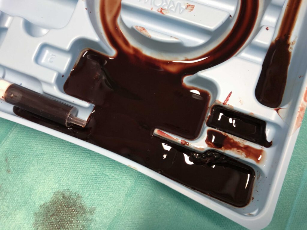 Braunes Blut tut nicht gut: 
Vergiftungen mit Natriumnitrit und anderen Met-Hb-Bildnern
toxdocs.de/2022/methb/