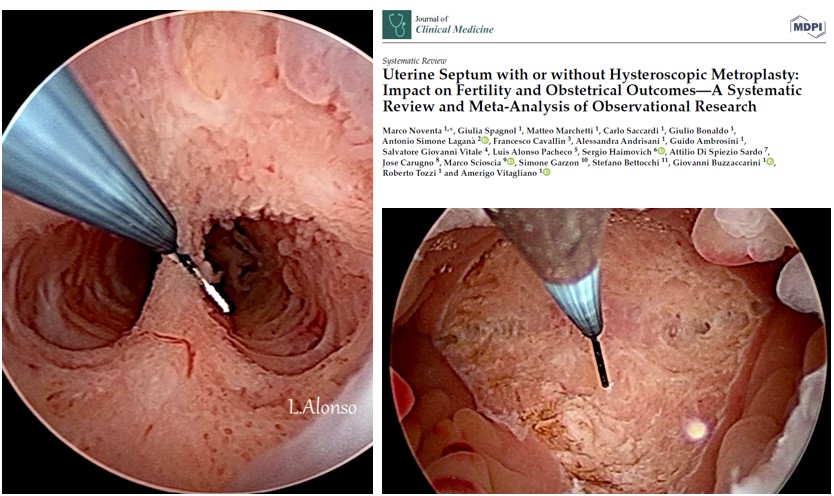 Septum resection may be effective in increasing the live birth rate and reducing the risk of spontaneous abortion in women with poor reproductive histories. mdpi.com/2077-0383/11/1…