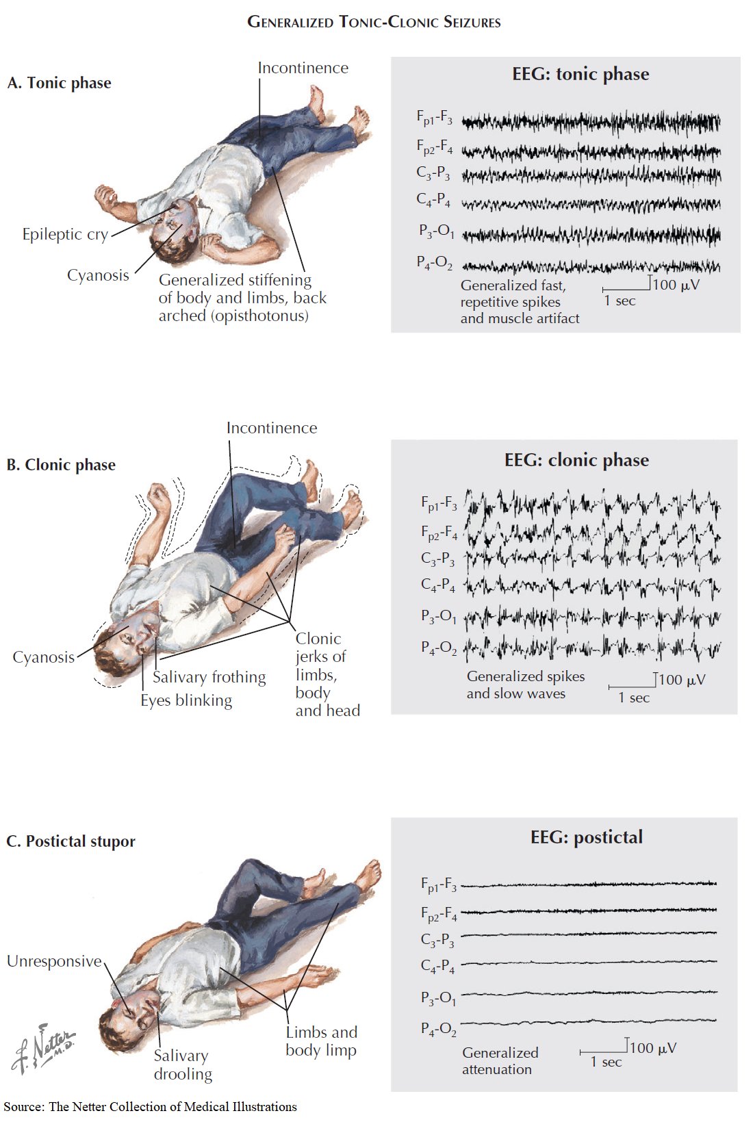 Tonic clonic seizure eeg
