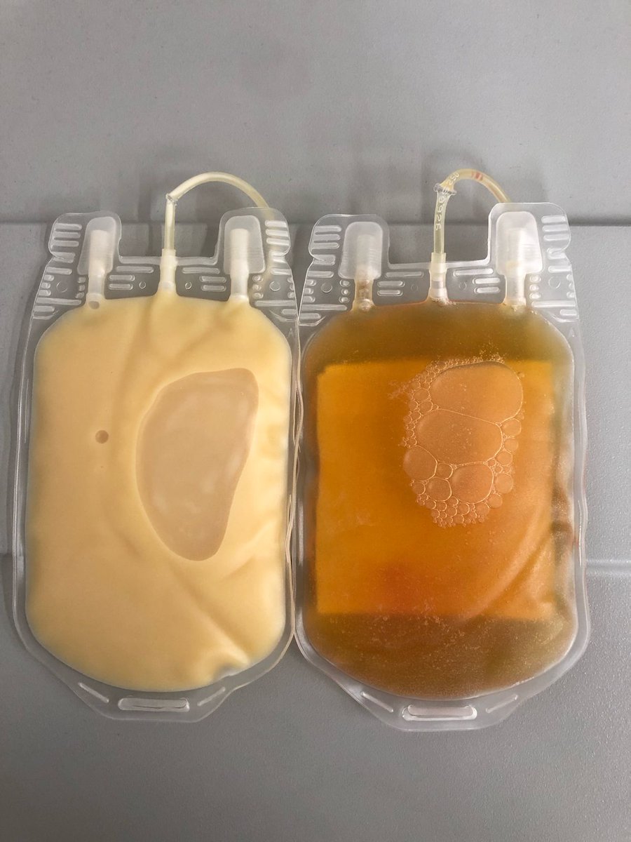 jonathanvicent's tweet photo. Plasma lipemico (esquerdo) e um plasma normal (direito)

Plasma lipemico é resumidamente o acúmulo de colesterol no organismo.

Ocorrendo com a ingestão de comidas com alto teor de gorduras, sendo frequentemente ou em caso de metabolismo lento.

Foto: Kassia Peres https://t.co/NR1Rdvw6cm