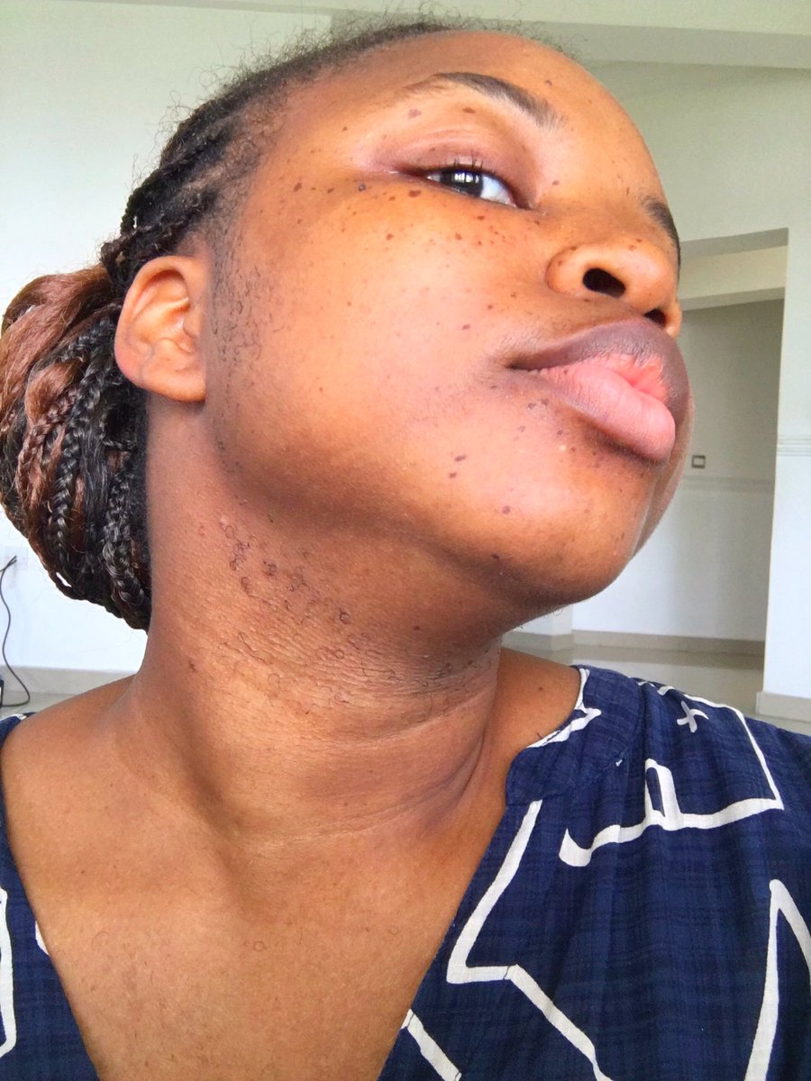 precious_nsa's tweet image. 💐Proud Girl Moment 💐
-
I was diagnosed with PCOS (Polycystic Ovarian Syndrome) on Christmas eve in 2020, after months of dealing with a long list of symptoms including facial hair, and the last two years of living with it have been tough in every sense of the word..