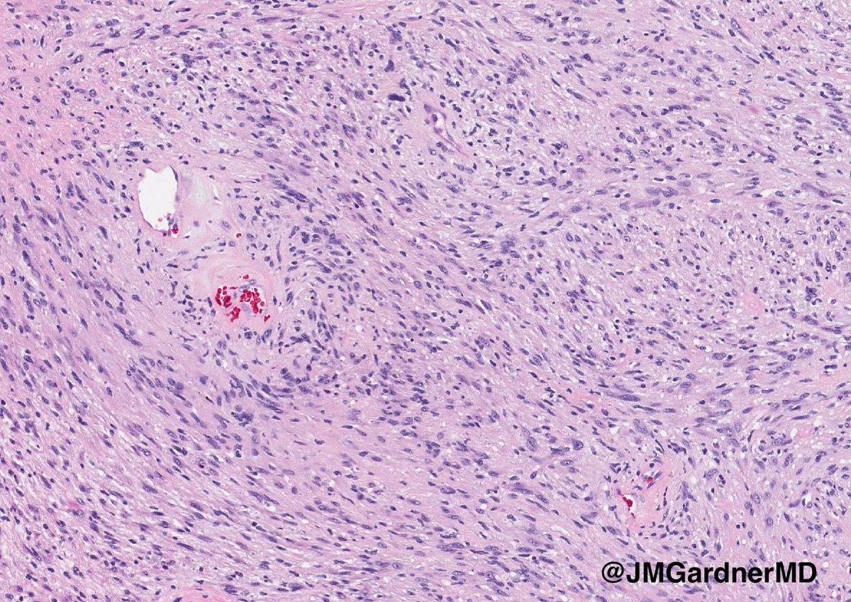 "Cyst" on the trunk of an adult. Your diagnosis? (Hint: it's not a cyst!) 
Answer: kikoxp.com/posts/8892
Video: kikoxp.com/posts/4093
#pathology #pathologists #pathTwitter #dermpath #dermatology #dermatologia #dermtwitter #BSTpath
