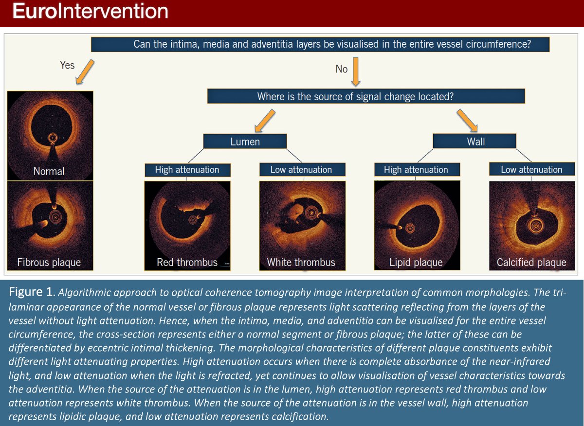 A comprehensive overview on the utility of #OCT in coronary artery disease, including technical details, device set-up, simplified image interpretation and an algorithmic approach for using OCT in PCI guidance. #EIJBestOf <a href="/ziadalinyc/">Ziad Ali</a> #Cardiotwitter ow.ly/PLsa50LvgIX