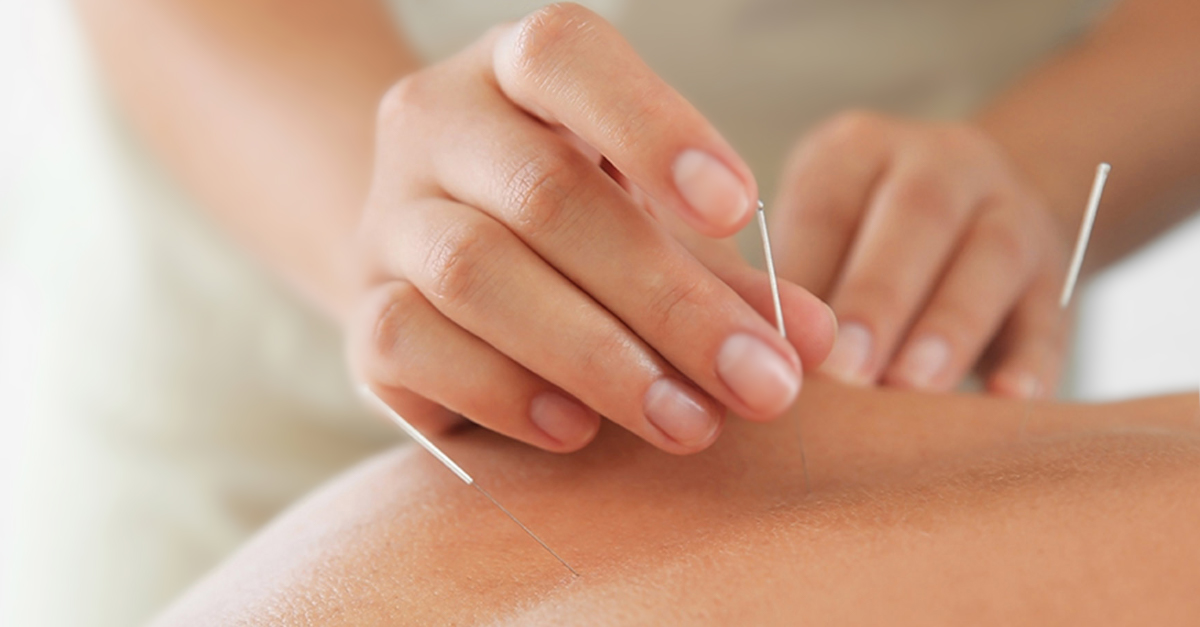 Have sciatic nerve pain? Give acupuncture a try. Some research shows that it may work even better than traditional treatment for back pain. There's little risk as long as you find a licensed practitioner. wb.md/3tEwsfv
