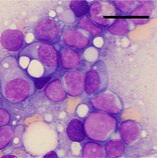A 60 year old man presented with weakness. Laboratory studies were unremarkable except for absolute lympocytosis in the peripheral blood.Bone marrow biopsy showed finding in the image. What is your diagnosis? #pathtweetorial #pathboards #hematology #hematologyboards #pathresident