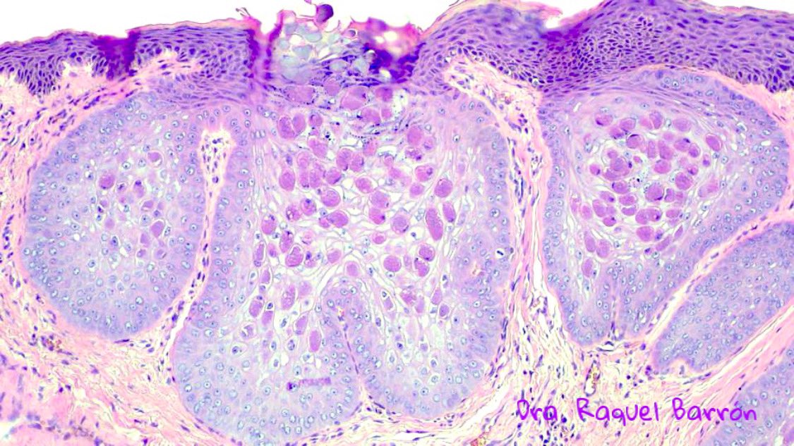 😍 It is always beautiful to see Molluscum contagiosum in the glans. #PathTwitter #path 😍🔬