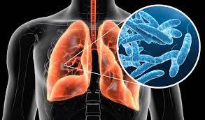 DrGokhaleAGK's tweet photo. Legionnaires Disease Symptoms and Causes
#LegionnairesDisease is an acute form of pneumonia. It is a kind of #LungInflammation caused by an infection of a bacteria called legionella bacteria (hence the name of the disease)...
Know more at: https://t.co/JM6lIosow8 https://t.co/e1otQPNenI