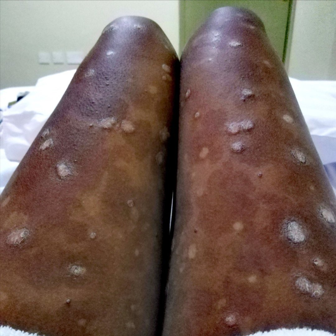 PsoriasisIFPA's tweet photo. There may be many barriers to receiving a diagnosis. Skin color should not be one of them. IFPA is working with health care professionals and patient advocates to close the gap for #psoriaticdisease.

Visit https://t.co/EwAAp3S7Tt to learn more.

#skinclusivity #psoriasis https://t.co/QY71q1Z3kN