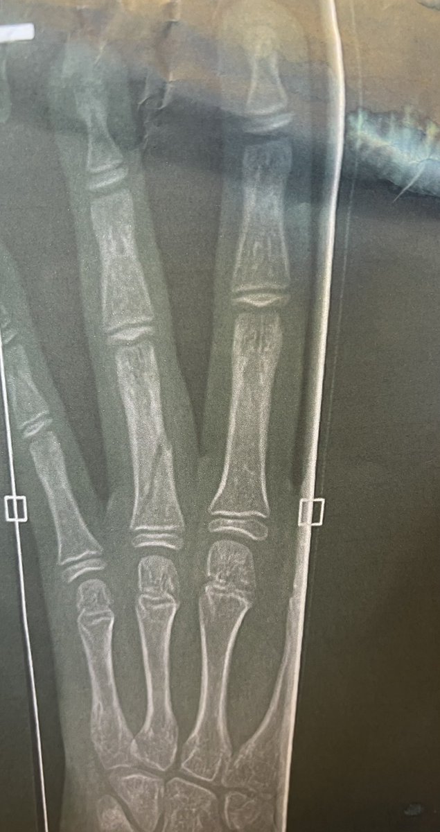 When a year 7 hands in their X-ray of their broken hand for their natural forms research homework! 👏🏻 #EducationWithCharacter <a href="/NPitmanRE/">N Pitman</a> <a href="/TCAPoole/">The Cornerstone Academy Poole</a>