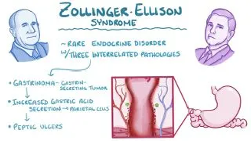 TheAAES's tweet photo. Zollinger-Ellison Syndrome is caused by a gastrinoma. Secretion of gastrin causes increased gastric acid and peptic ulcers that are typically refractory to medical treatment.
#NETAM2022 #NeuroendocrineTumor #LetsTalkAboutNETs
@NANETS1 @CarcinoidNETs @LACNETS @PheoPara https://t.co/2xjrnanhHe