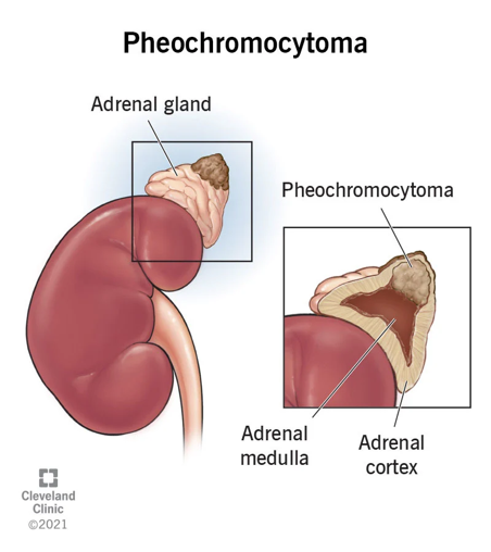 TheAAES's tweet photo. Pheochromocytomas and Paragangliomas occur in the adrenal gland or sympathetic nerves. They secrete adrenaline hormones that cause high blood pressure, anxiety, palpitations, headache, tremor, sweating.
#NETAM2022 #NeuroendocrineTumor
@NANETS1 @CarcinoidNETs @LACNETS @PheoPara https://t.co/ShvKnDQFDm