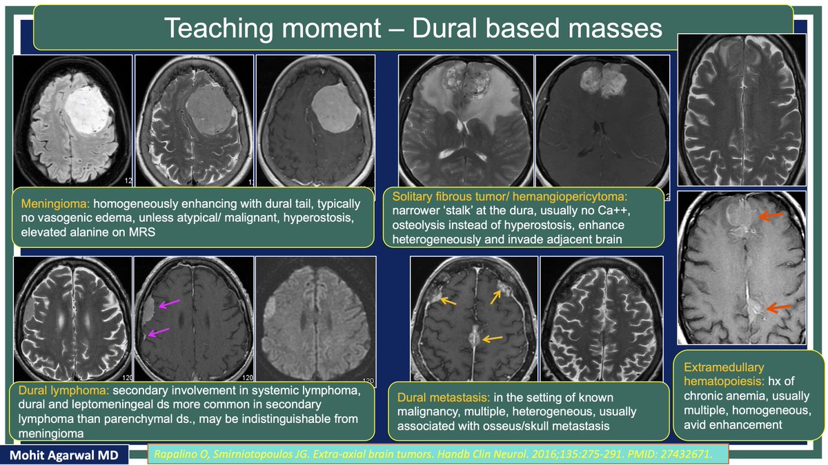 #MCWNeuroradBTW 090 Ans:Meningioma Check out #TeachingMoment on Dural masses #FOAMed #radres #MedEd @TheASNR @ARRS_Radiology @BSHNI_UK @ESNRad @BshniTrainees @ESNRad @bdoop3210 @MCWNeurorad @AwanRad @aaronrutman @ShivaprakashBH4 @drSurjthVattoth @RamVaidhyanath @ASHNRSociety