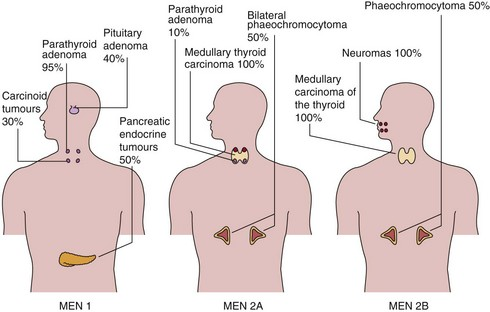 TheAAES's tweet photo. Medullary thyroid cancer (MTC) is a NET that arises from the parafollicular c-cells in the thyroid gland. MTC is usually sporadic, but can also be seen with MEN 2a/2b.
#NETAM2022 #NeuroendocrineTumor #LetsTalkAboutNETs
@NANETS1 @CarcinoidNETs @LACNETS @PheoPara https://t.co/trYQtA9WZ0