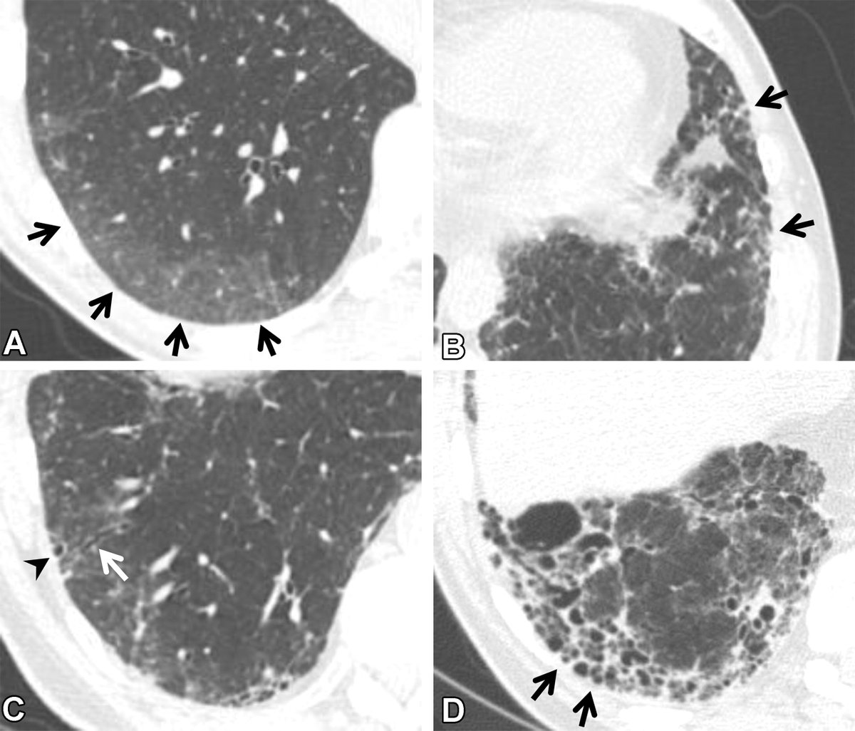 RadioGraphics (@radiographics) on Twitter photo Interstitial lung abnormalities (ILAs) are a chest CT incidental finding with management & prognostic implications. Learn more about ILAs, including risk factors and associations with lung cancer, in this review! bit.ly/3zEUhYb Interstitial lung abnormalities (ILAs) are a chest CT incidental finding with management & prognostic implications. Learn more about ILAs, including risk factors and associations with lung cancer, in this review! bit.ly/3zEUhYb