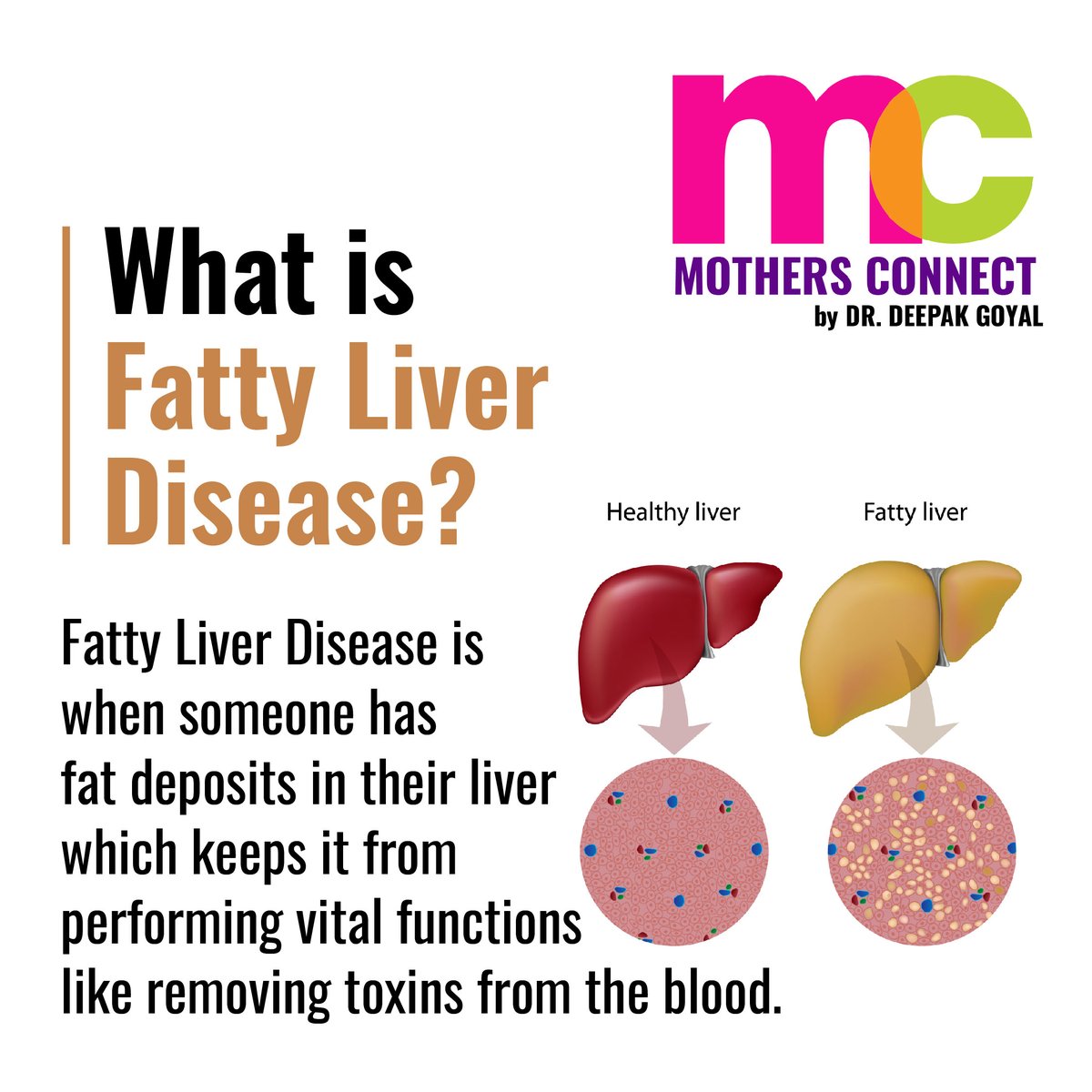 dr_deepakgoyal's tweet photo. #drdeepakgoyal #mothersconnect #childrenhealth #liverdisease #jaundice #fattyliver #hepatitis #NAFLD #nafldcare #Gurgaon https://t.co/zlNhf9Vd8a