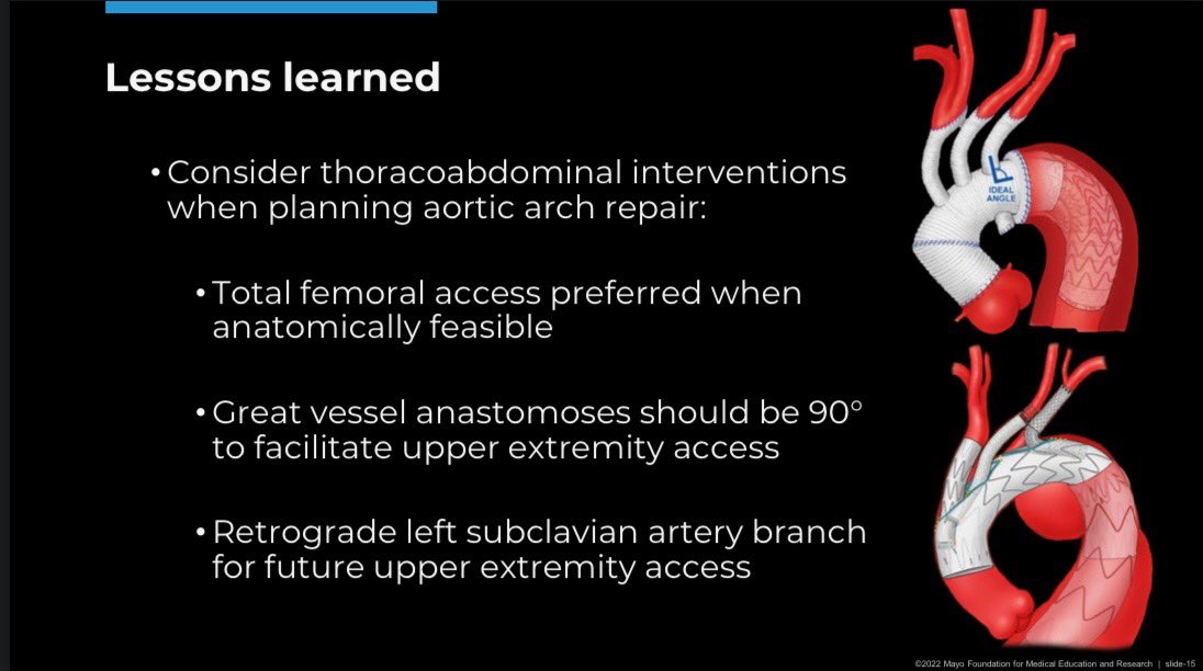 Mayo Clinic Vascular and Endovascular Surgery (@mayovascsurgery) on Twitter photo Stellar pgy3 <a href="/jessechait/">Jesse Chait</a> (<a href="/drbermendes/">Bernardo Mendes</a>, <a href="/GustavoOderich/">Gustavo Oderich</a>, <a href="/randydemartino/">Randall DeMartino</a>) presents the Mayo experience and lessons learned about total aortic repair and FB-EVAR from aortic valve to iliac arteries! #VEITH22 #AortaEd Stellar pgy3 <a href="/jessechait/">Jesse Chait</a> (<a href="/drbermendes/">Bernardo Mendes</a>, <a href="/GustavoOderich/">Gustavo Oderich</a>, <a href="/randydemartino/">Randall DeMartino</a>) presents the Mayo experience and lessons learned about total aortic repair and FB-EVAR from aortic valve to iliac arteries! #VEITH22 #AortaEd