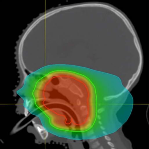 Read a presentation of dental late effects following childhood #HeadAndNeckCancer treatment from a collaboration between <a href="/MFTnhs/">MFT NHS</a> <a href="/TheChristieNHS/">The Christie NHS</a> <a href="/UFProtonTherapy/">UF Health Proton Therapy</a> dentists &amp; oncologists: bit.ly/IJPT-Winter-20…  <a href="/E_FosterThomas/">Emma Foster-Thomas</a> <a href="/simona_gaito/">Simona Gaito</a> #protontherapy