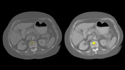 Radiology_AI's tweet photo. #DeepLearning bone mineral density tool performed better than feature-based image processing tool https://t.co/HQ2fxzCmHU @UWiscRadiology @NIHClinicalCntr #MSKRad #BMD #MachineLearning #FSS22 https://t.co/K0chiKG3gh