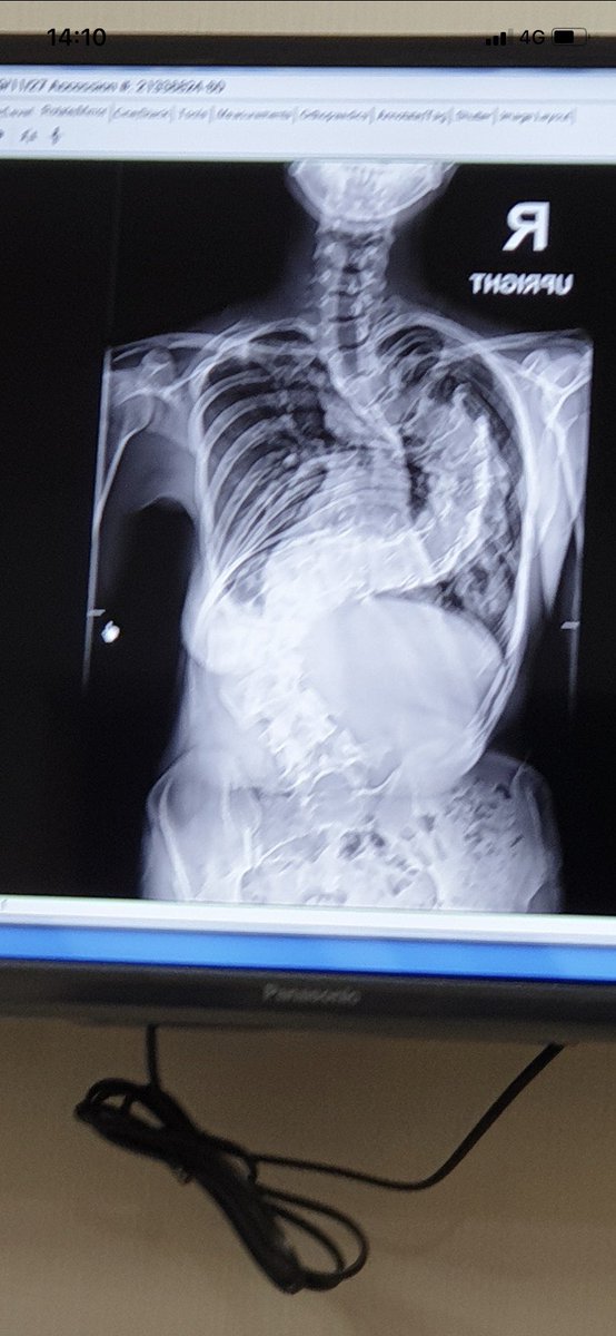 สวัสดีค่า เราอยากมาแชร์ประสบการณ์ผ่าตัดกระดูกสันหลังคดทั้งสองรอบ ในวัย 20-22 ของเรา ซึ่งคดแบบค๊ดดด องศา s curve รวมกัน 110+ องศา ไม่ได้เชี่ยวชาญด้านนี้นะงับ แค่อยากแชร์ปสกเพื่อให้เป็นประโยชน์ต่อหลายๆคนที่อาจกำลังเผชิญหรือมีคนใกล้ตัวเป็นอยู่💗 (เทรดน่าจะยาวมากๆๆ)