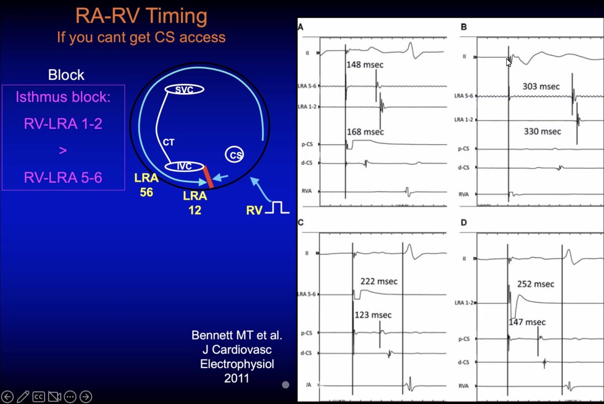 Amazing how there’s always something to learn something from Fellows’ conference, even when it’s about typical flutter. Slide from <a href="/JoeAkar1/">Joe Akar</a> today on assessing CTI block without using a CS catheter.

Totally going to use this in a future Fontan/Mustard case