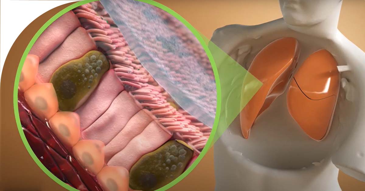Longfonds's tweet photo. De mini-long is dé medische doorbraak waar we op wachten. Hij is cruciaal voor het vinden van een oplossing voor #longschade, zoals #COPD. Hoe dit precies werkt? Ontdek het in de video 👉 https://t.co/5EGLydupQS https://t.co/Hc2TyrZHOk