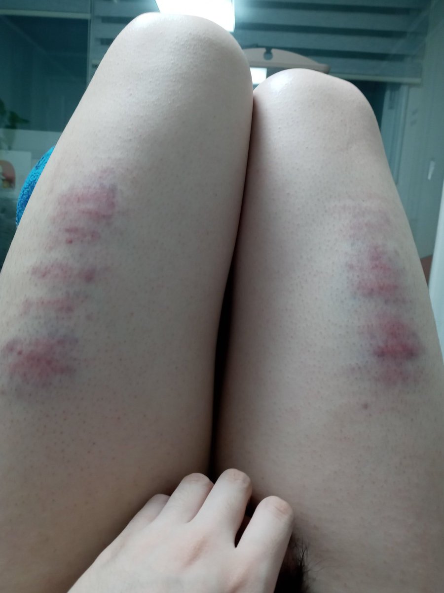 MSspankee031's tweet photo. 시작할때 맞고 벌서면서 맞고 쉴때도 맞고 오컨할때고 맞고 계속해서 맞은날 
빠른 회복력 덕분에 일주일만에 90%나은듯 또 맞고 싶다

#스팽 #멜섭 #펨돔 #멜키 #펨커 https://t.co/C7HKLatPkp