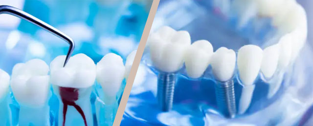 Choosing Between Dental Implants and Root Canal Therapy. Which procedure is best for your troubled tooth?

Explore the difference: asleepfordentistry.com/blog/differenc…

#rootcanal #dentalimplant #sleepdentistry